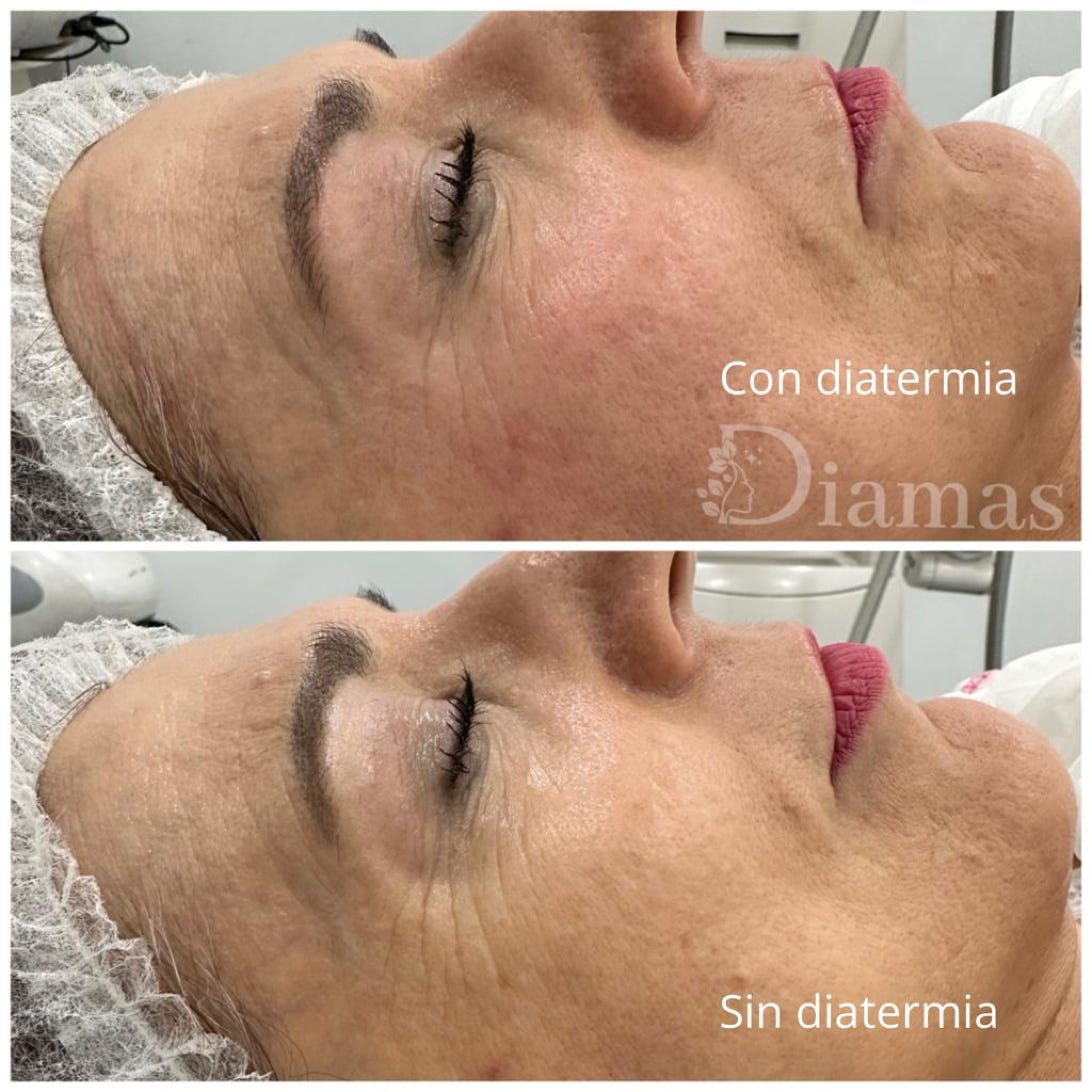 DIATERMINA MALAGA, TRATAMIENTO DIATERMIA, CLINICA ESTETICA MALAGA