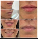Rellenos de labios. Acido hialuronico. Aumento de labios, hidratación de labios.